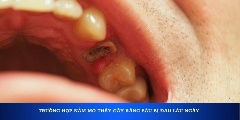 Trường hợp nằm mơ thấy gãy răng sâu bị đau lâu ngày