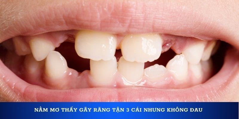 Nằm mơ thấy gãy răng tận 3 cái nhưng không đau